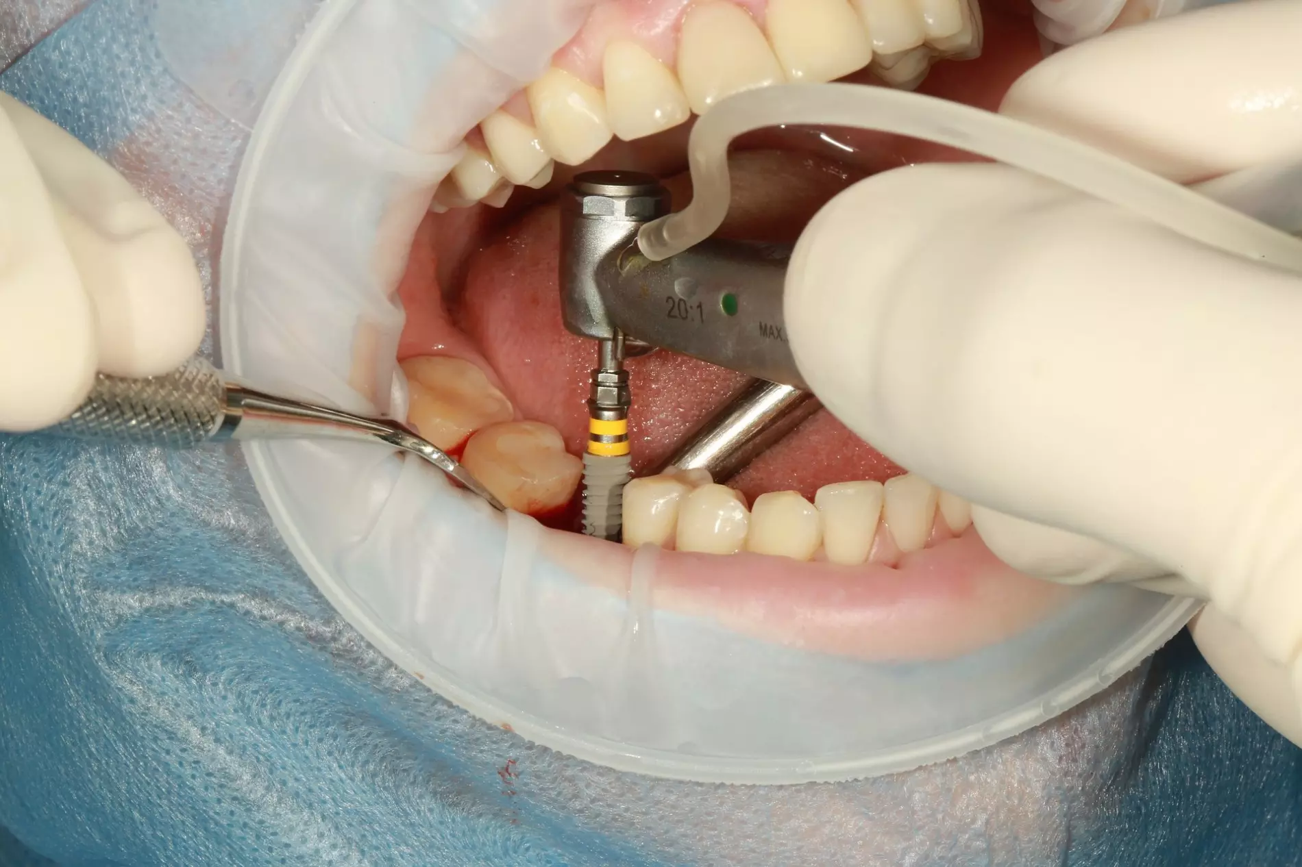 Hình ảnh thực tế cấy ghép impant